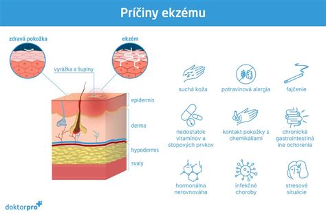 Príčiny a spúšťače atopického ekzému
