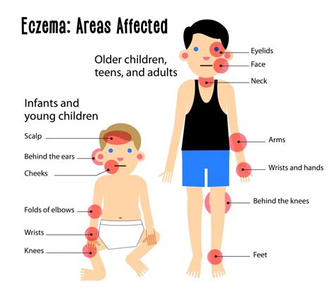Infographic on common locations of atopic eczema in infants