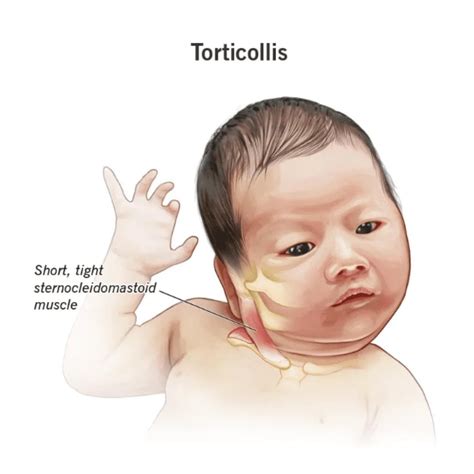 Dieťa s torticollis
