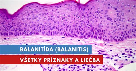 Príznaky zápalu predkožky