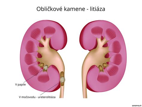 Obličky a obličkové kamene