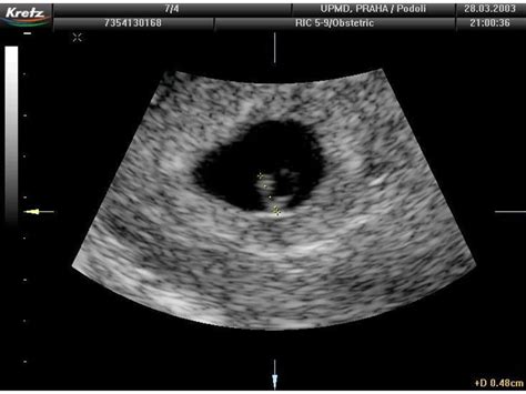 Umenie tehotenstva: ultrazvukové zobrazenie embrya
