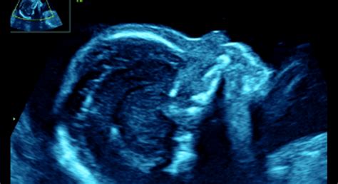 Ultrazvukový pohľad na rastúce bábätko v druhom trimestri