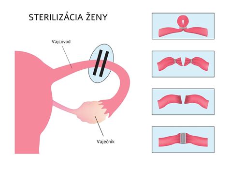 Trvalá neplodnosť: sterilizácia