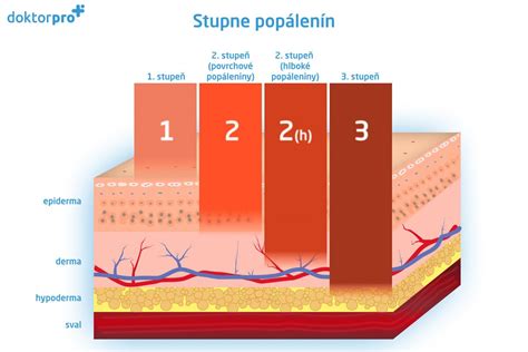 Stupne popálenín a ich vizuálne prejavy