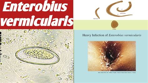 Detailný pohľad na Enterobius vermicularis (mrľu detskú)