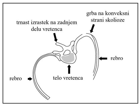 Adamsov test predklonu pri diagnostike skoliózy