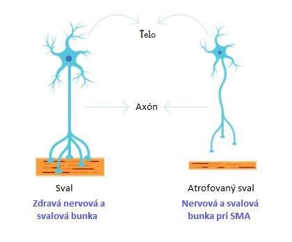 Porovnanie zdravého neurónu a svalovej bunky so SMA neurónom a svalovou bunkou