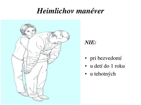 Heimlichov manéver u staršieho dieťaťa