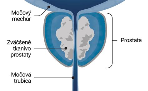 Diagram znázorňujúci zväčšenú prostatu tlačiacu na močovú trubicu.