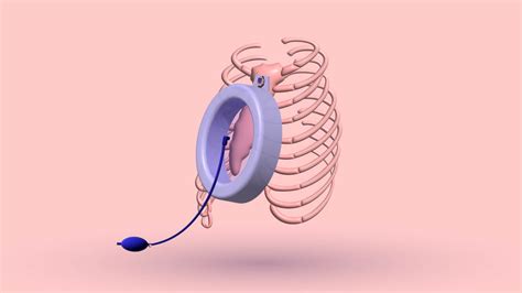 ilustrácia vacuum bell terapie