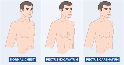 porovnanie pectus excavatum a pectus carinatum