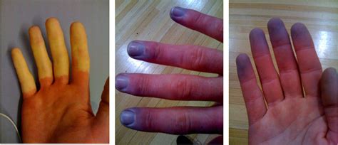 Obrázok znázorňujúci zmeny farby prstov pri Raynaudovom syndróme