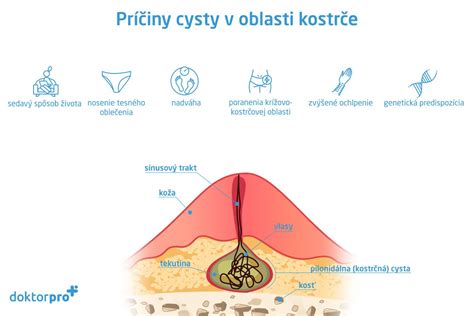 Základná štruktúra cysty v tkanive