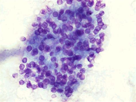 Mikroskopický obraz Pneumocystis jiroveci v pľúcnom tkanive