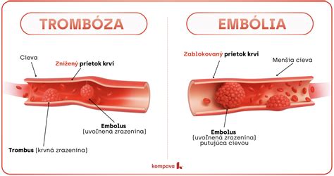 Krvná zrazenina v žile