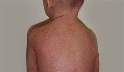 Dojča s atopickým ekzémom na tvári