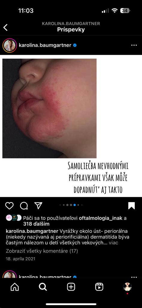 Ilustrácia periorálnej dermatitídy s detailným zobrazením papúl okolo úst.
