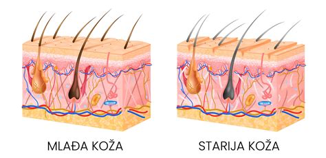Schéma: Zdravá koža vs. koža postihnutá vitiligom s detailom melanocytov