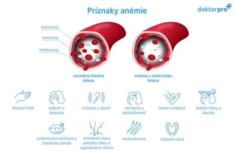 Infografika znázorňujúca rôzne príznaky nedostatku železa