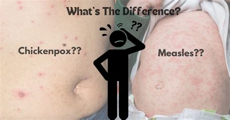 Comparison of chickenpox rash in children vs. adults