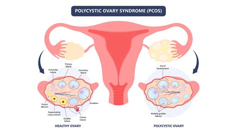 Polycystické vaječníky (PCOS) - schéma
