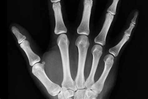 Röntgenový snímok ruky s detailom na poškodený prst