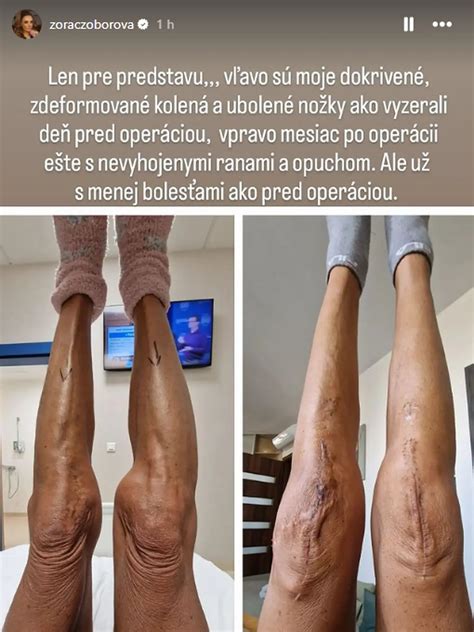 Zotavenie po operácii kolena