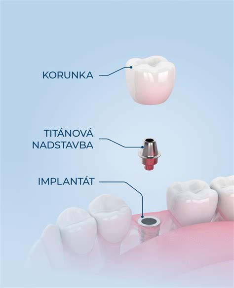 Vizualizácia fungovania kochleárneho implantátu.