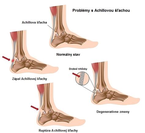 anatomické znázornenie achillovej šľachy