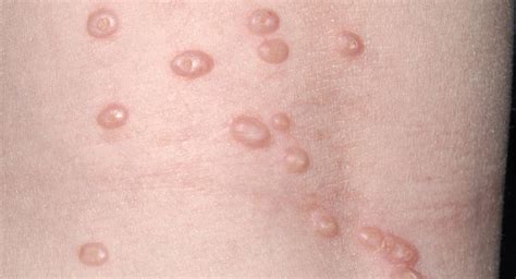 Typické prejavy Molluscum contagiosum na koži