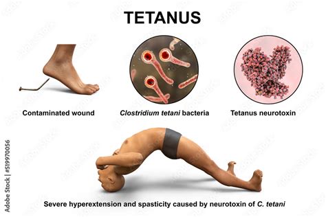 Opistotonus - typický prejav generalizovaného tetanu