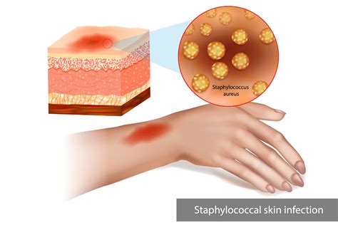 Ilustrácia bakteriálnej infekcie kĺbu