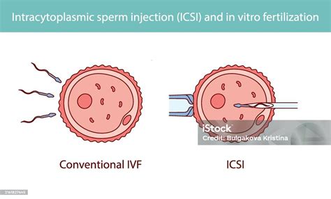 Schéma fertilizácie vajíčka spermiou (ICSI)