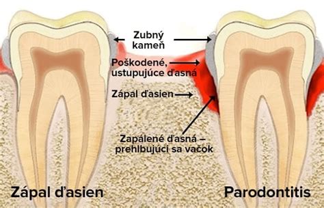 Zdravé ďasná vs. zápal ďasien