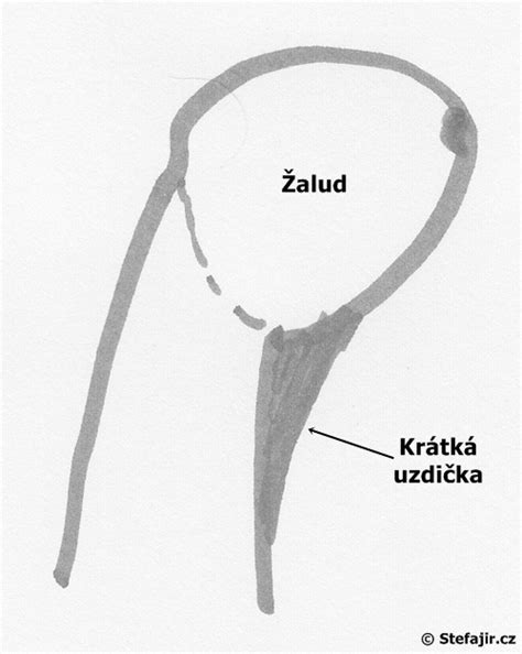 Prirastená podjazyková uzdička u dojčaťa
