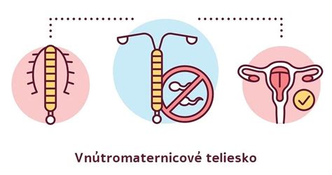 Schéma zavedenia vnútromaternicového telieska v maternici