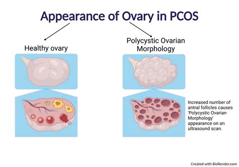 PCOS ovaries vs normal ovaries diagram
