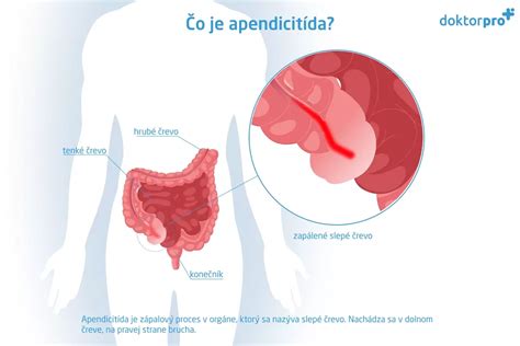 Lokalizácia bolesti pri zápale slepého čreva