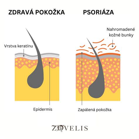Zobrazenie aplikácie gélu na postihnuté miesto na pokožke