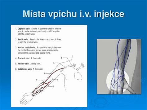 Diagram subkutánnej injekcie Fraxiparinu do brucha