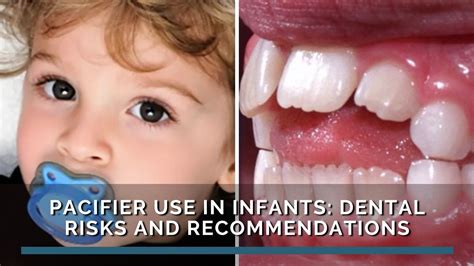 Diagram comparing physiological pacifier use to finger sucking dental impact