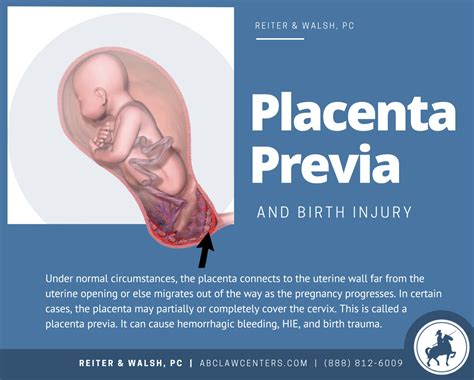 Zadržaná placenta