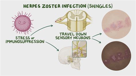 Infografika: Neonatálny herpes a jeho prejavy