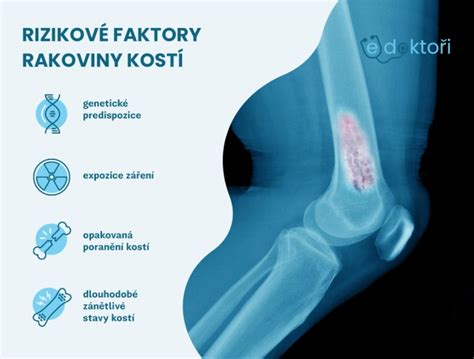 Obrázok zobrazujúci rizikové faktory rakoviny semenníkov