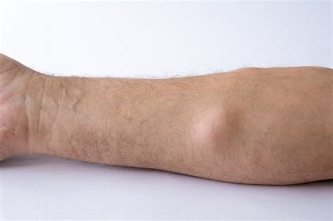 Detailná štruktúra hematómu pod kožou