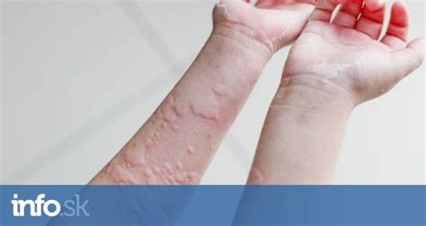Alergická reakcia na pokožke