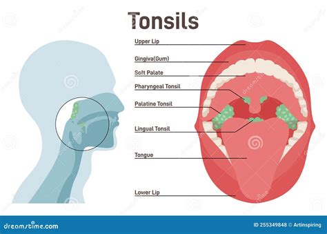 Diagram of tonsil types