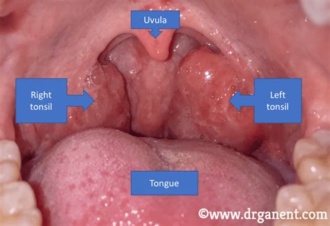Comparison image: Tonsil stone vs. Purulent tonsil
