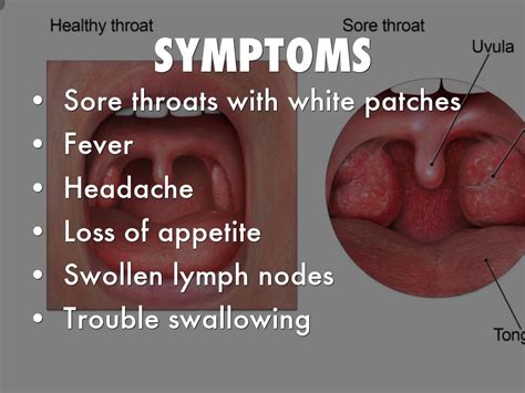 Sore throat and swollen lymph nodes